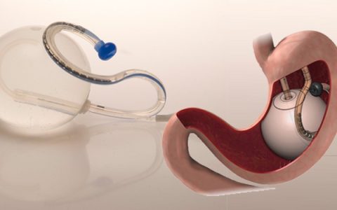 Gastric Balloon in Dubai