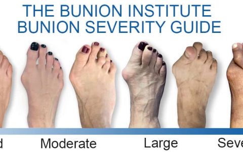 Bunion Treatment