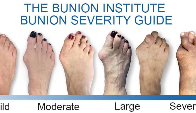 Bunion Treatment
