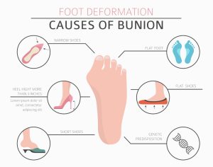 Bunion Treatment