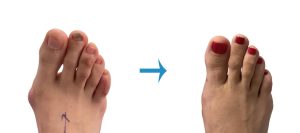 Key Advantages of Minimally Invasive Bunion Correction