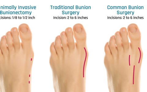 Minimally Invasive Bunion Correction