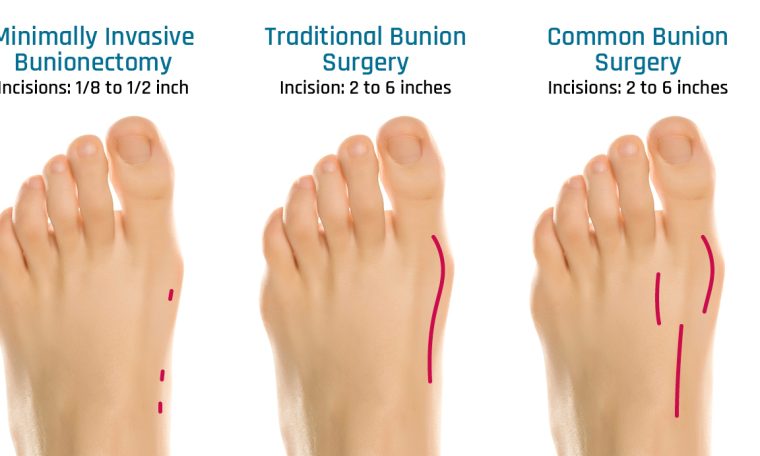 Minimally Invasive Bunion Correction