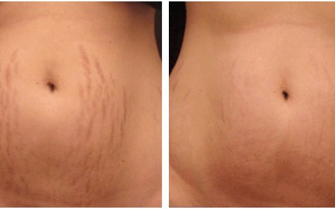 Light Stretch Marks in Torrance