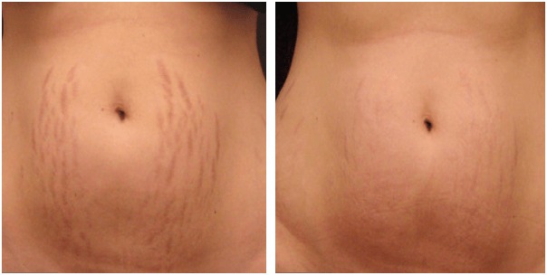 Light Stretch Marks in Torrance