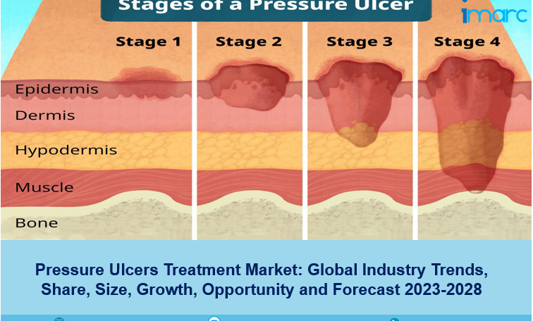 Pressure Ulcers Treatment Market