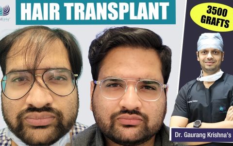 hair transplant cost in bangalore