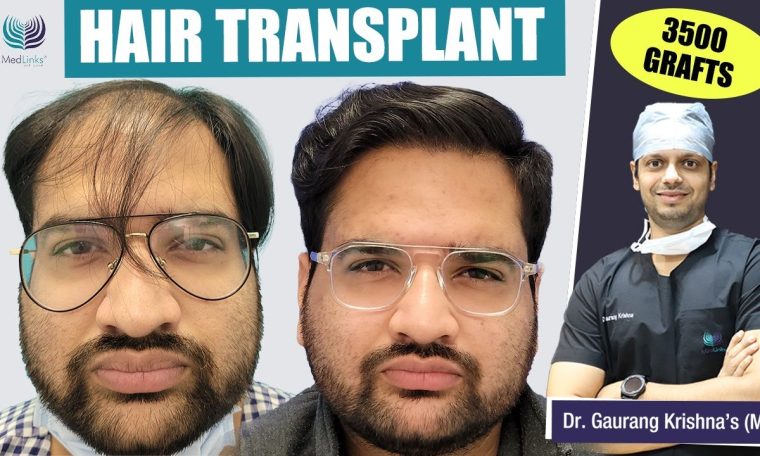 hair transplant cost in bangalore